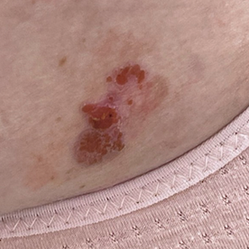 皮膚惡性腫瘤-鱗狀細胞癌(照片由劉康玲醫師提供).png